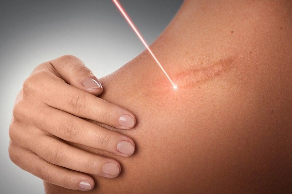Laser Neodinio YAG 1064nm/532nm